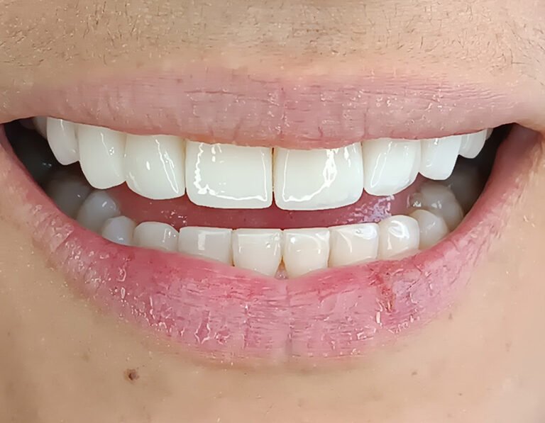 diseno-sonrisa-2B