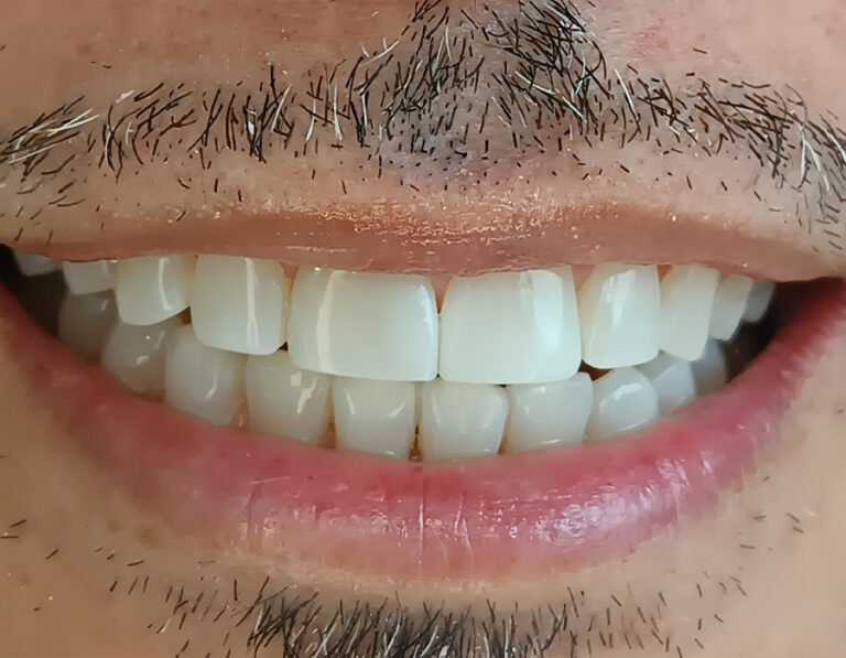 diseno-sonrisa-3B
